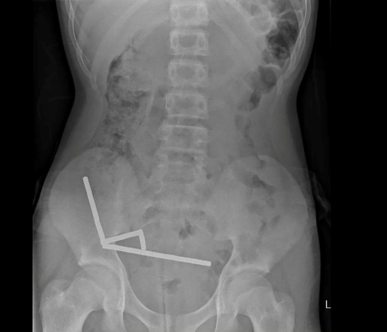 Surgeons remove up to 100 magnets from N. Zealand teen's gut